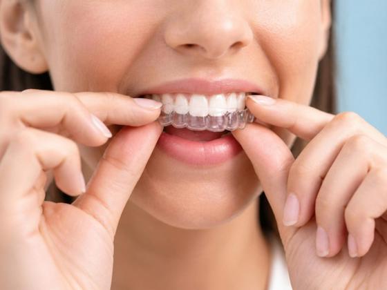 Fitting a clear aligner
